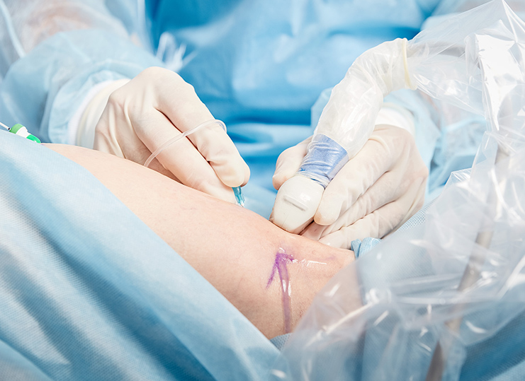 ELVeS 1470 laser treatment. phlebology clinic