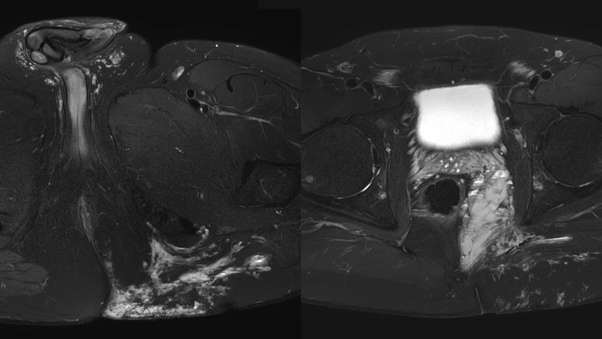 Venous malformation in the pelvic, buttock and perineal region - magnetic resonance (MR) image showing details of vascular lesions. Advanced diagnosis of venous malformations in the Department of Phlebology.
