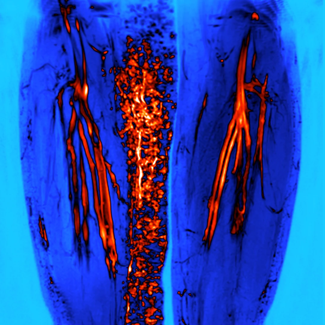 Complex venous malformation - MR venography image showing lower limb vascular anomaly. Diagnosis of venous malformations by magnetic resonance imaging in the Department of Phlebology.