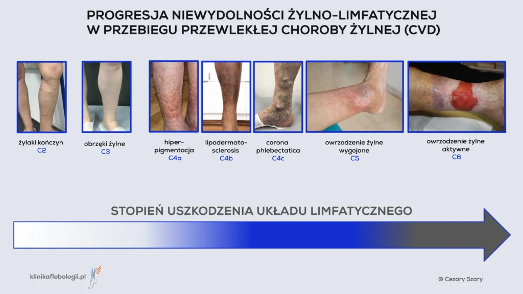 Diagram showing the progression of venous-lymphatic insufficiency in the course of chronic venous disease (CVD). The infographic contains 7 clinical images arranged from left to right, showing the progression of the disease according to the CEAP classification. Author: Cezary Szary