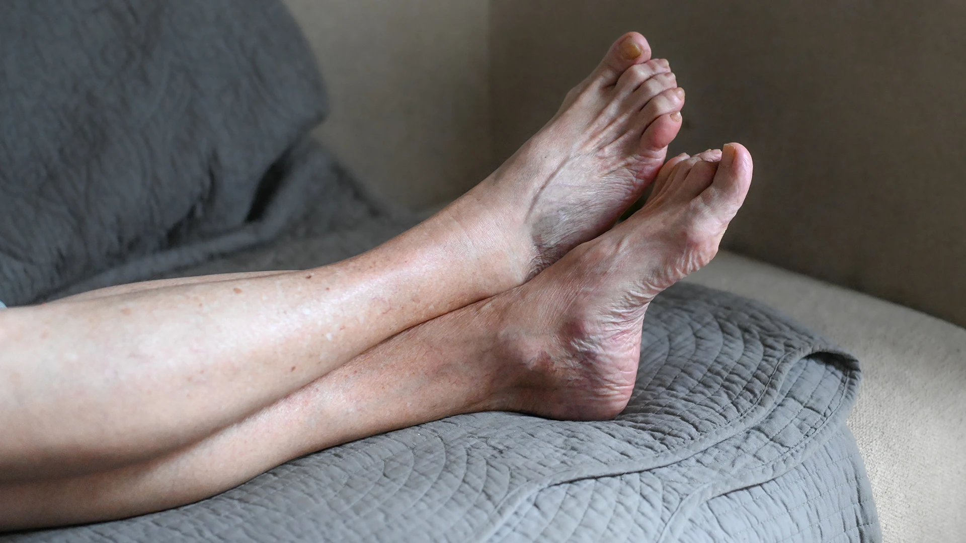 Photograph of the legs of a woman with visible skin lesions due to venous disease.