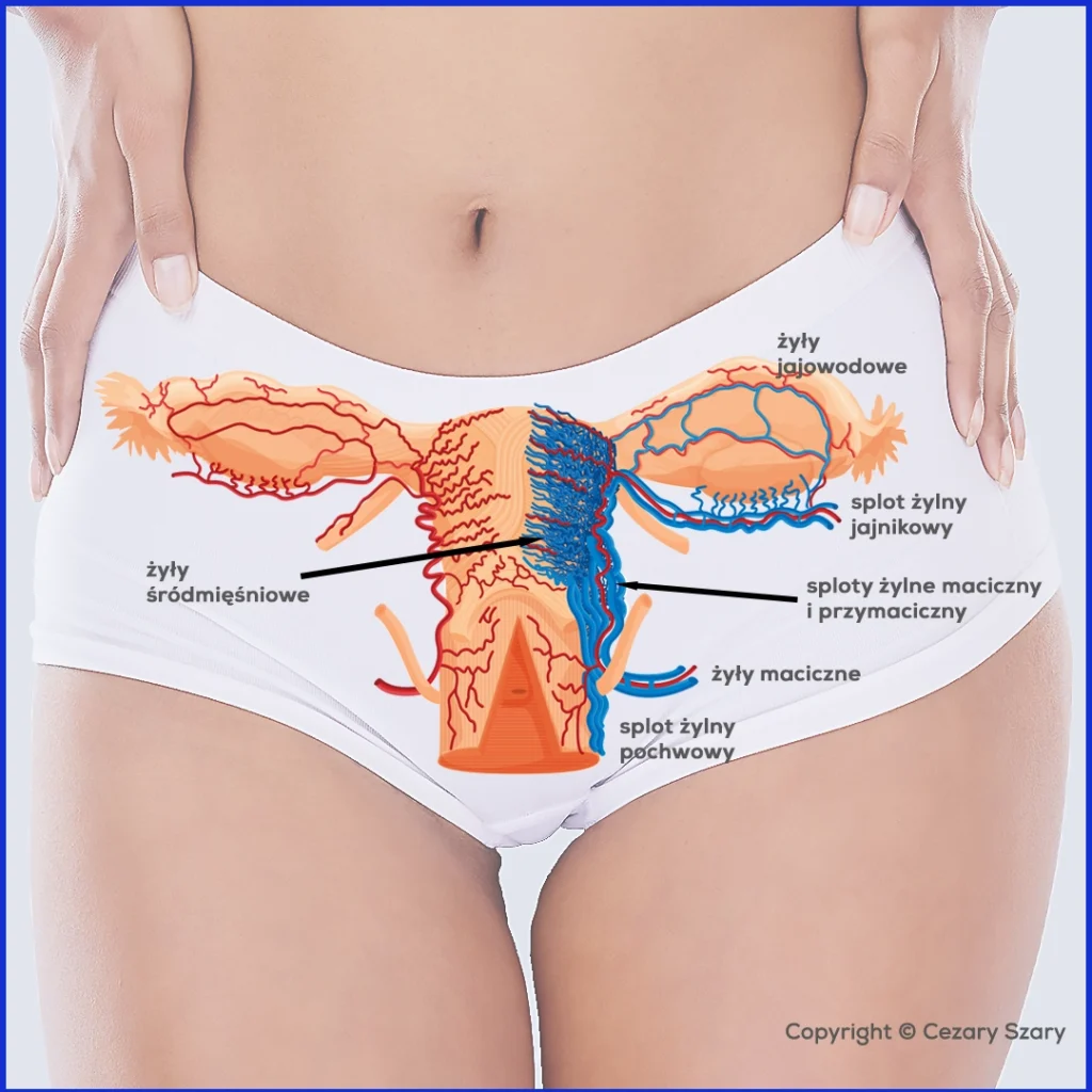 Veins of the uterus and adnexa. Varicose veins of the parametrium. Diagram of the pelvic veins. Cezary Szary