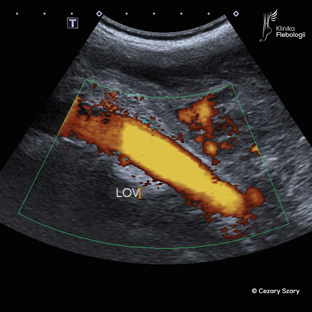 Widened left ovarian vein on venous Doppler ultrasound. Cezary Szary