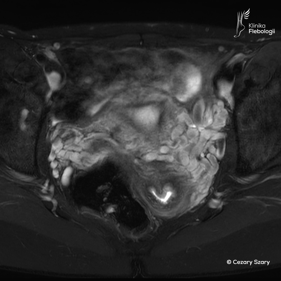 MR venography. Varicose veins of the parenchyma. Cezary Szary