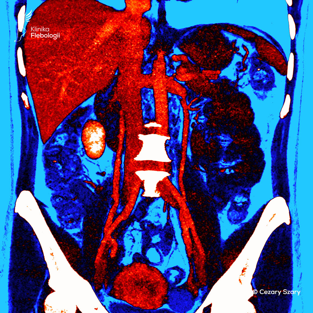 Widening of the ovarian veins. CT venography. Cezary Szary